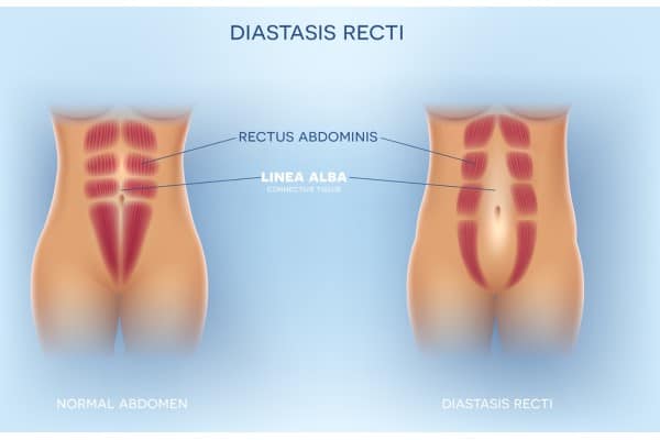 What Non-Surgical Options Are Available for Diastasis Recti Twyford?