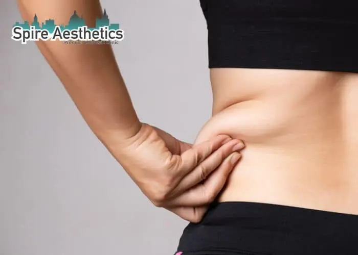 Image of woman pinching fat on their hips Twyford. Fat Freezing treatment