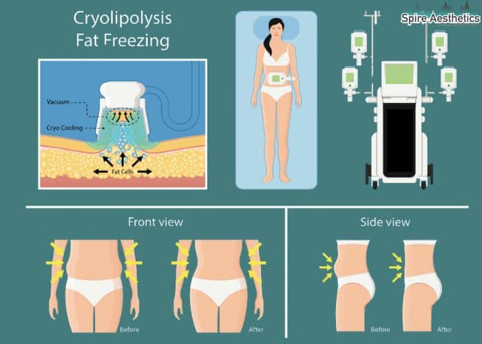 Image of diet and fat freezing combined for best results for Spire Aesthetics Twyford
