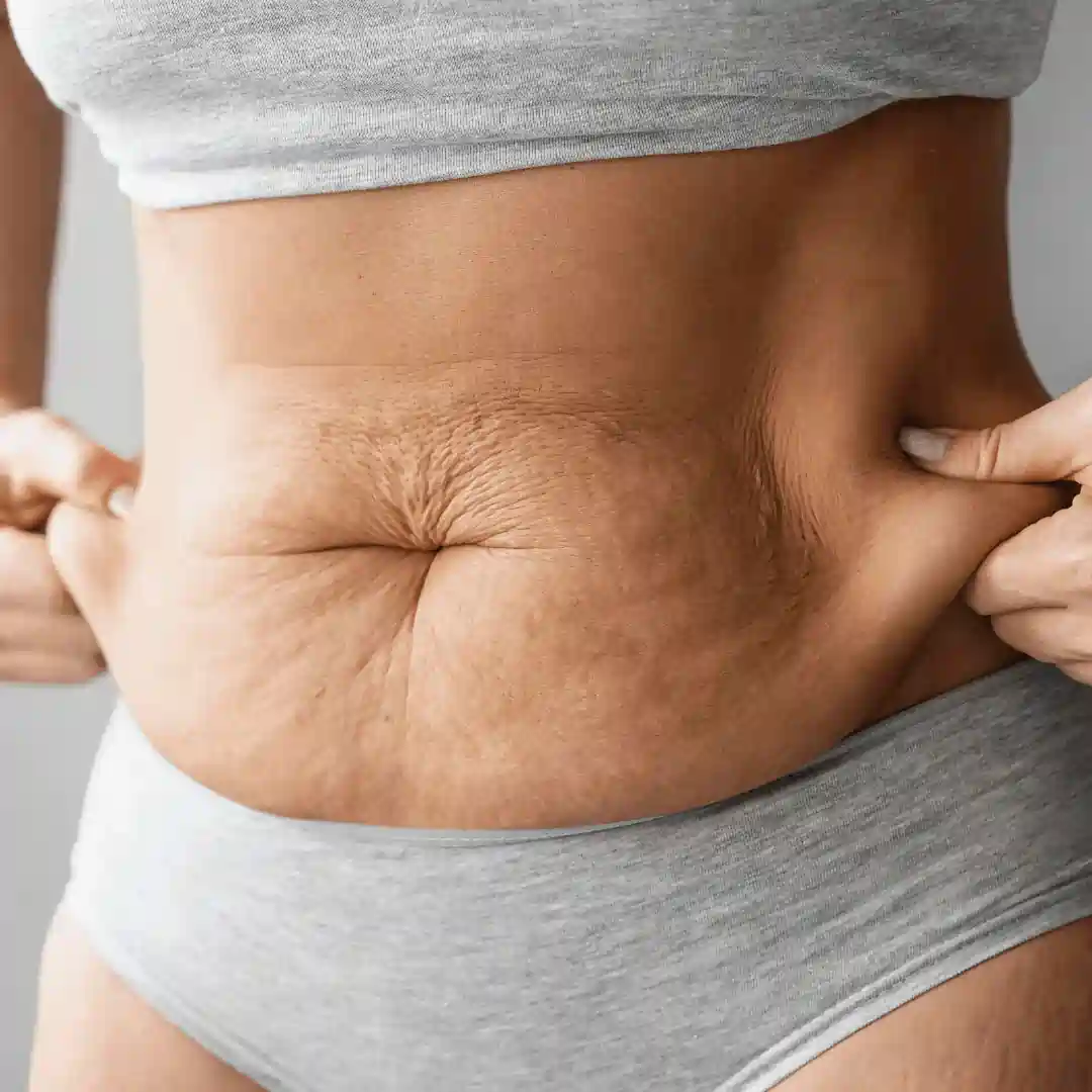 Is It Normal to Have Loose Skin After Pregnancy Twyford?