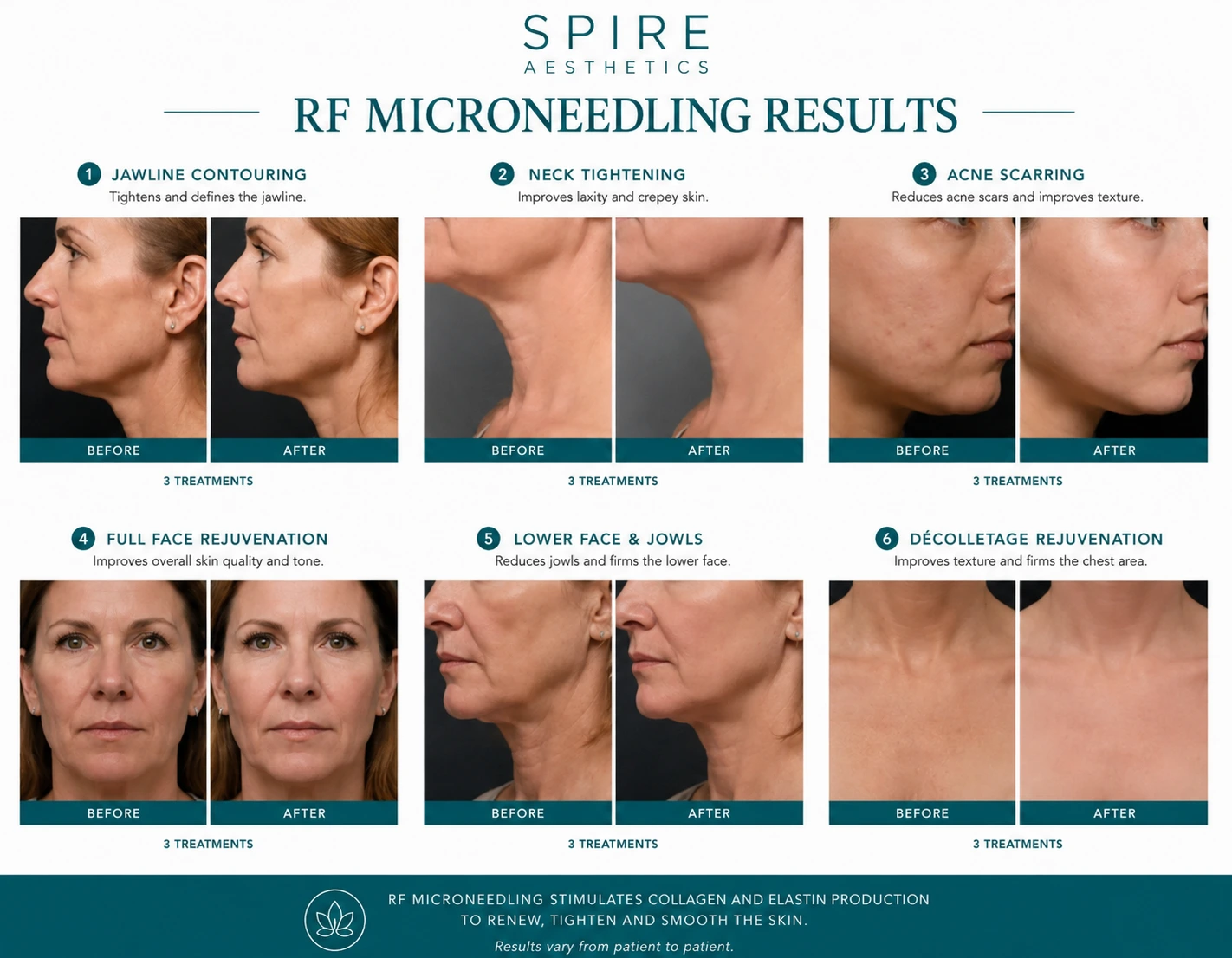 RF Microneedling Skin tightening Twyford results
