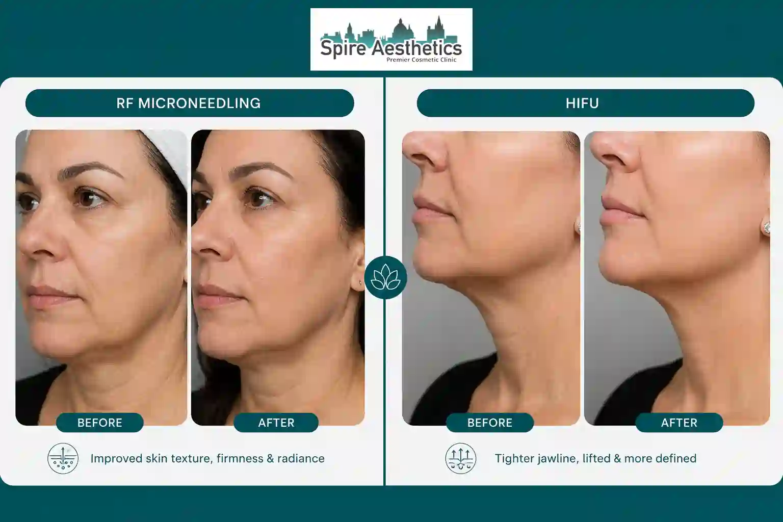 Can RF Microneedling and HIFU Be Combined Twyford?