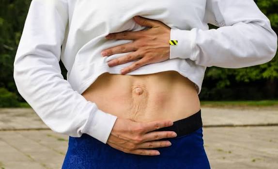 When Could Diastasis Recti Be the Missing Piece of the Puzzle Twyford?
