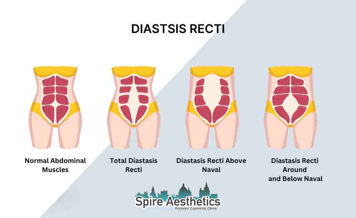 Is Non-Surgical Diastasis Recti Treatment Right for You? Common Concerns Answered Twyford